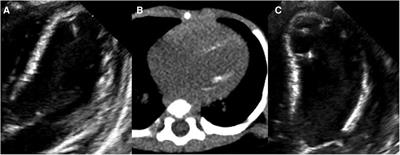 Case Report: Rapid and progressive left ventricular endocardial calcification in an infant with Williams syndrome